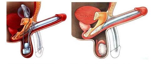 Proteză peniană cu proteză gonflabilă (stânga) și plastic (dreapta)