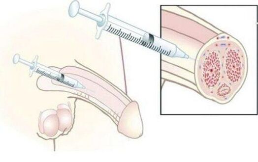 Injuarea injecțiilor cu acid hialuronic