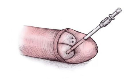 Capul penisului poate fi mărit prin injectarea de gel hialuronic în el