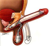 Implanturi de mărire a penisului masculin