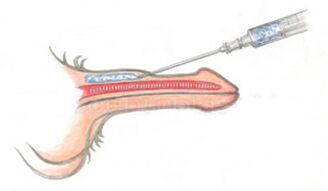 Volumizarea injecției cu acid hialuronic în penis